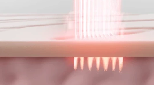 分数二氧化碳激光与其他皮肤表面修复治疗：哪个选择是最好的？