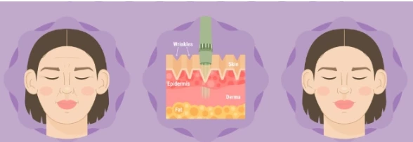 手持式HIFU系列（第二部分）为什么热成像和射频设备不能取代HIFU（超疗）？