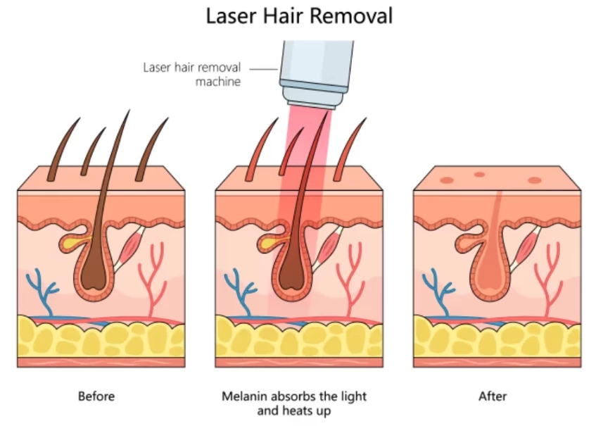 无痛激光脱毛：是什么让808二极管激光舒适和有效