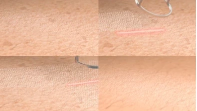 分数二氧化碳激光与其他皮肤表面修复治疗：哪个选择是最好的？